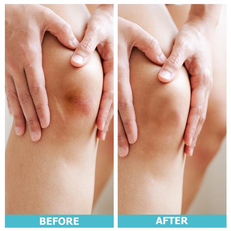 LIFARA Hydrocolloid Acne Roll
